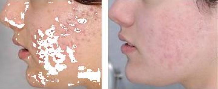 Tratament dermato-cosmetic acnee activa de la Centru Medical, Estetica & Spa Medical