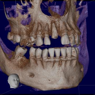 Tomografie 3D (CBCT) articulatii ATM / TMJ